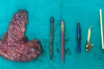 Mắc hội chứng Pica khiến người bệnh tự 'nuốt đủ thứ' vào bụng