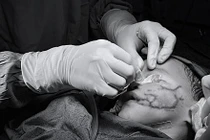 Thương tâm bé 2 tuổi bị chó cắn nham nhở khắp vùng mặt