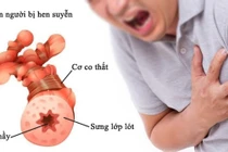 Kiểm soát bệnh hen phế quản để tránh biến chứng nguy hiểm