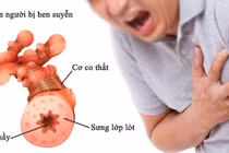 Kiểm soát bệnh hen phế quản để tránh biến chứng nguy hiểm