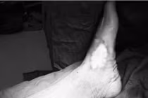 Người đàn ông bị áp xe, nhiễm khuẩn huyết do chủ quan với vết xước nhỏ