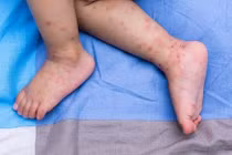 Bệnh tay chân miệng do virus đường ruột gây ra