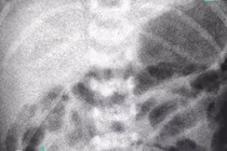 Cứu sống bé trai sinh non mắc teo ruột hiếm gặp tại Cần Thơ