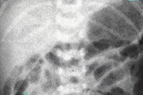 Cứu sống bé trai sinh non mắc teo ruột hiếm gặp tại Cần Thơ