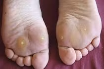 Cách cải thiện chai chân hiệu quả, dễ thực hiện