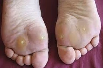 Cách cải thiện chai chân hiệu quả, dễ thực hiện