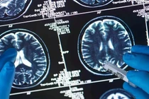 Công nghệ mới giúp chẩn đoán ung thư não chính xác hơn 