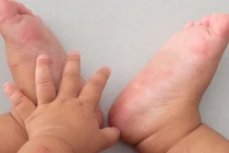 Phòng tránh bệnh tay chân miệng cho trẻ nhỏ trong mùa dịch