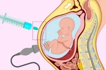 Thai phụ thiểu ối nặng tuần 31, sinh con an toàn ở tuần 39