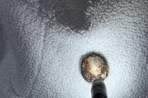 Trẻ 11 tháng tuổi nuốt pin cúc áo, hậu quả nghiêm trọng