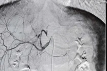 Kỹ thuật can thiệp mạch cứu bệnh nhân 15 tuổi vỡ gan độ IV tại Quảng Ninh