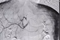 Kỹ thuật can thiệp mạch cứu bệnh nhân 15 tuổi vỡ gan độ IV tại Quảng Ninh