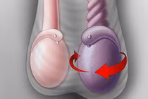 Cần phát hiện sớm xoắn tinh hoàn để tránh hoại tử