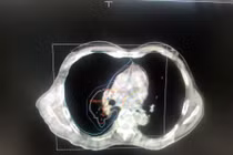 Điều trị ung thư phổi bằng phương pháp kết hợp hoá xạ trị mang lại hy vọng