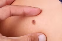 Ung thư hắc tố da nguy hiểm, cách phòng tránh hiệu quả