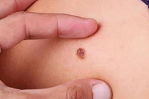 Ung thư hắc tố da nguy hiểm, cách phòng tránh hiệu quả