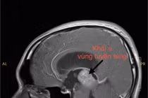 Thanh niên trẻ mắc u vùng tuyến tùng hiếm gặp được điều trị thành công 