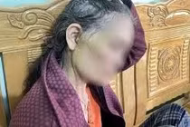 Người phụ nữ U70 biến chứng nặng sau căng da mặt tại spa