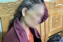 Người phụ nữ U70 biến chứng nặng sau căng da mặt tại spa