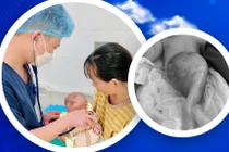 Hồi phục kỳ diệu của bé sơ sinh thoát vị rốn lớn nhất từ trước tới nay
