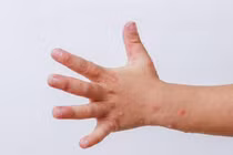 Bệnh tay chân miệng tăng mạnh ở TPHCM, bác sĩ cảnh báo gì?