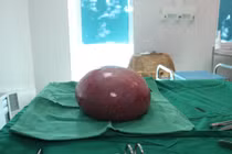 Người phụ nữ ở Lai Châu thoát khỏi khối u xơ tử cung lớn sau ca mổ thành công