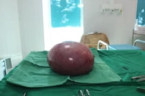 Người phụ nữ ở Lai Châu thoát khỏi khối u xơ tử cung lớn sau ca mổ thành công