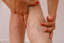 Cách đơn giản giúp phòng ngừa suy giãn tĩnh mạch