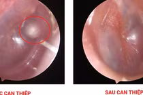 Phát hiện bất ngờ khối Cholesteatoma bẩm sinh trong tai trẻ nhỏ 11 tháng tuổi