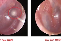 Phát hiện bất ngờ khối Cholesteatoma bẩm sinh trong tai trẻ nhỏ 11 tháng tuổi