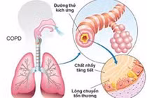 Bệnh hen và phổi tắc nghẽn khác nhau thế nào?