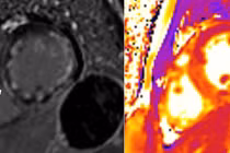 Hồi sinh bệnh nhân trẻ bị ngưng tim do viêm cơ tim cấp