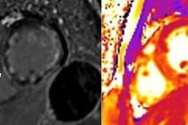 Hồi sinh bệnh nhân trẻ bị ngưng tim do viêm cơ tim cấp