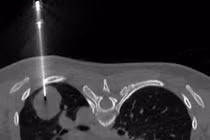 Người phụ nữ trẻ mắc ung thư phổi tế bào nuôi hiếm gặp