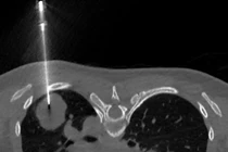 Người phụ nữ trẻ mắc ung thư phổi tế bào nuôi hiếm gặp