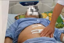 Phòng ngừa, điều trị thoát vị khe hoành sớm, tránh biến chứng nguy hiểm