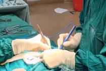 Điều trị thành công trẻ sơ sinh viêm phúc mạc do thủng ruột