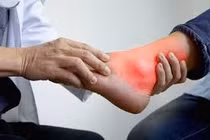 Lạm dụng corticoid trị gout có thể gây tàn phế