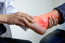 Lạm dụng corticoid trị gout có thể gây tàn phế