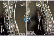 MRI tư thế trung gian và MRI tư thế gập cổ