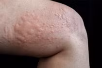 Nổi mày đay có thể do nhiều nguyên nhân khác nhau