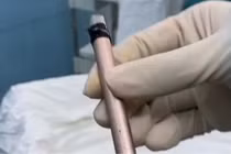 Dị vật bất ngờ trong bàng quang trẻ vị thành niên được xử lý an toàn