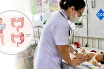 Một trẻ sơ sinh ở Nghệ An bị viêm ruột hoại tử vừa được các bắc sĩ cứu sống