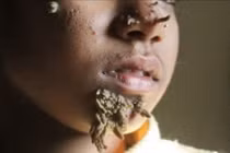 Việt Nam ghi nhận ca thứ hai mắc hội chứng 'người cây', bệnh nguy hiểm sao?