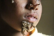 Việt Nam ghi nhận ca thứ hai mắc hội chứng 'người cây', bệnh nguy hiểm sao?