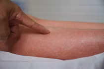 Dịch sốt xuất huyết tại Hà Nội tăng nhẹ trong tuần qua