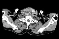 Phẫu thuật thành công ca ung thư tuyến giáp xâm lấn khí quản