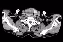 Phẫu thuật thành công ca ung thư tuyến giáp xâm lấn khí quản