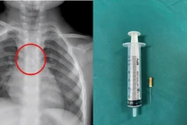 Bé 3 tuổi sặc kim chọc tủy vào đường thở nguy kịch