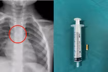 Bé 3 tuổi sặc kim chọc tủy vào đường thở nguy kịch